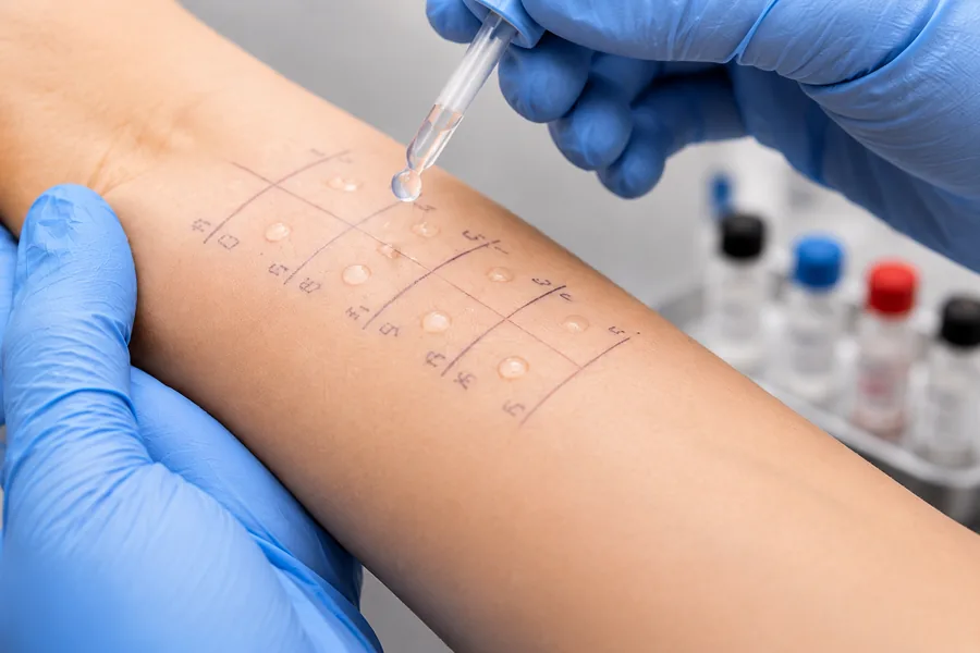 Allergietest am Unterarm